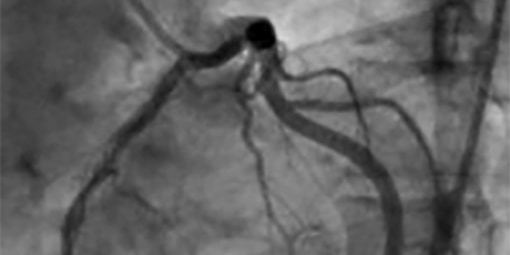 Coronary Angiography, The Cardiovascular Cantre